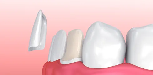 dental veneers