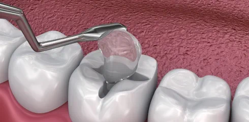 Dental Filling