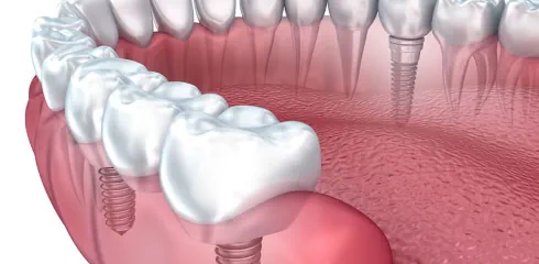 Dental Implant