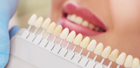 Teeth Whitening